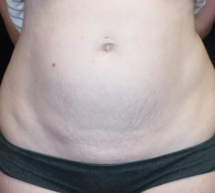 Stomach Morpheus8 Before and After, *Individual results may vary