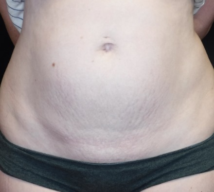 Stomach Morpheus8 Before and After