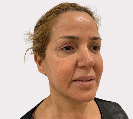 Liquid facelift