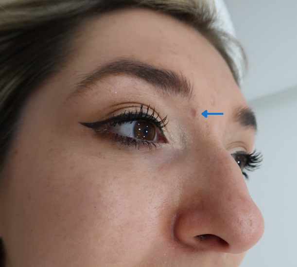 Before and after facial skin tag removed