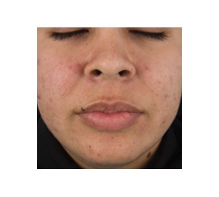 Before and after peel acne treatment
