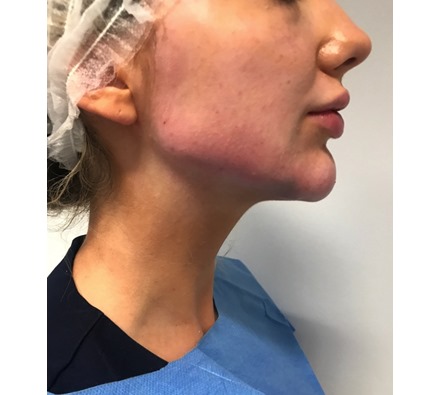 Before and after jawline filler