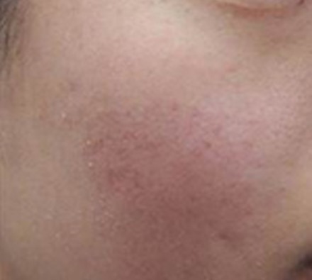 Before and after course of 6 Dermapen treatments