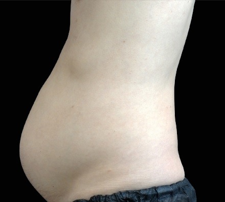 Male abdomen before and after EmSculpt Neo. Photos courtesy of David Kent, M.D.