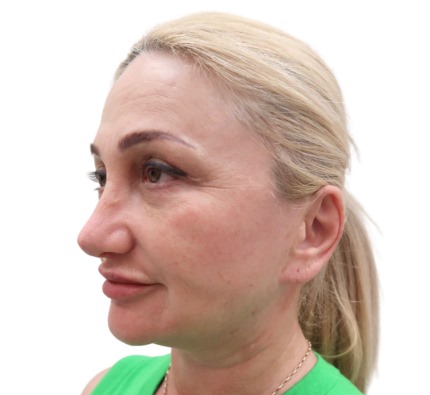 Before and after thread lift