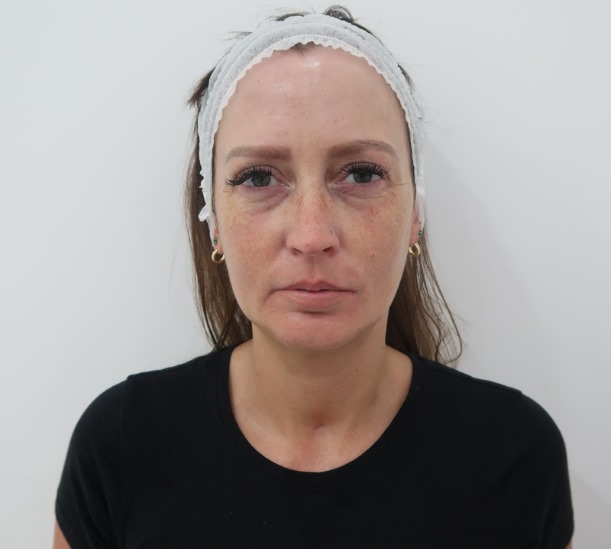Polynucleotide full face before and after