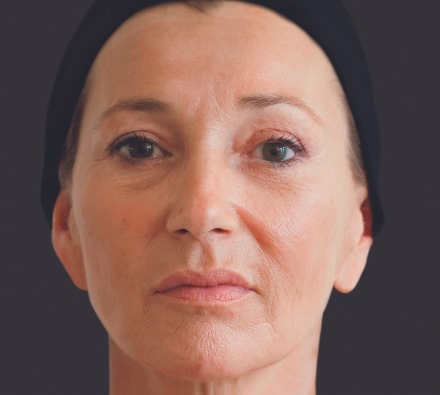 Here are some examples of the results we're able to achieve with Ellansé dermal filler...
