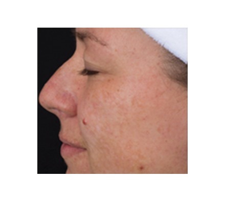 DermaClear (acne)