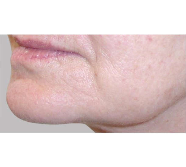 Before and After PRP Lower Jaw Therapy