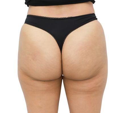 Lanluma Bum Lift Before and After