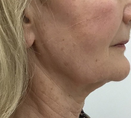 Ultherapy before and after (jowls)