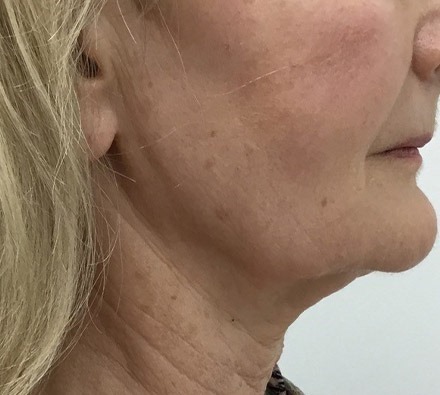 Ultherapy Jawline Before and After, *Individual results may vary