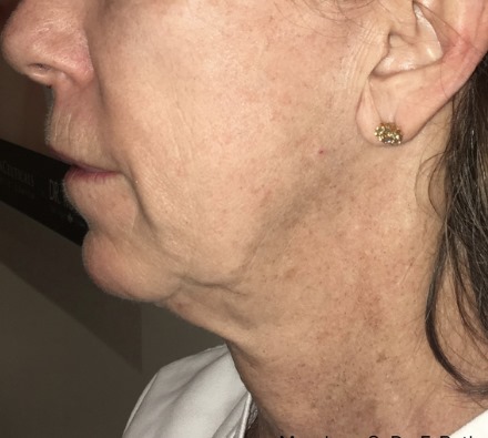 Neck before and after Morpheus8 treatment. Individual results may vary.