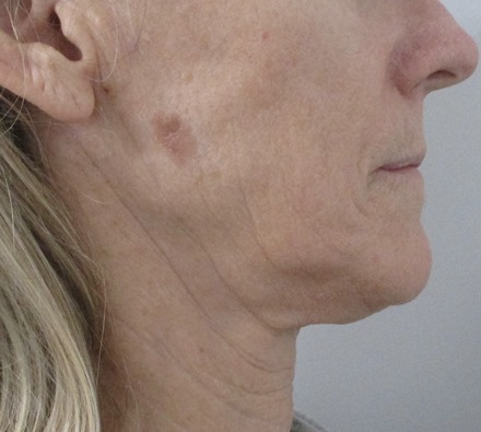 Lower Face Morpheus 8 Before and After, *Individual results may vary