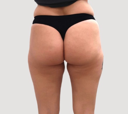 Before and after Lanluma non-surgical bum lift
