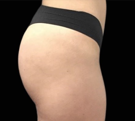 Buttocks before and after EmSculpt Neo. Photos courtesy of Seaside Aesthetics.