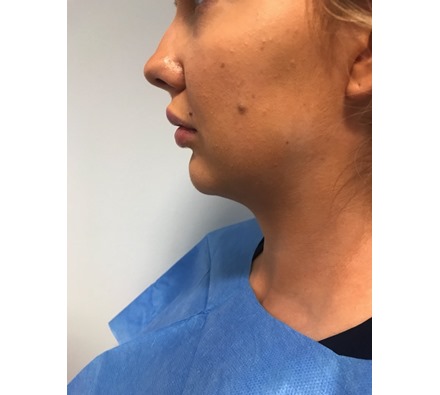 Before and after jawline and chin dermal filler