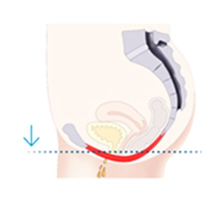 Pelvic floor Before and After Emsella treatment 