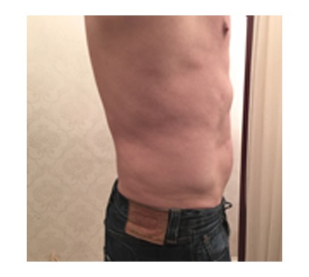 Fat dissolving injection