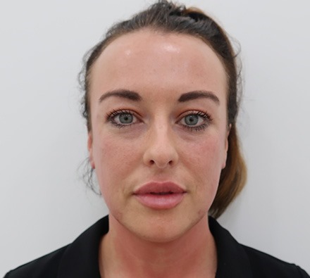 Lip filler before and after (1ml)