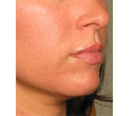 Ultherapy Lower Face Before and After, *Individual results may vary