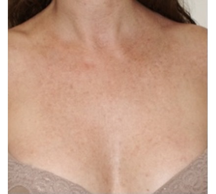 Pigmentation laser décolletage