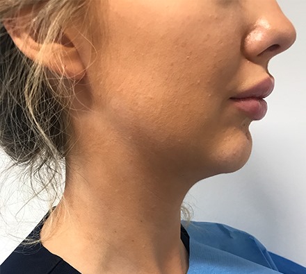 Chin and jawline filler before and after