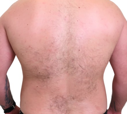 We treated this person's back acne with Hydr02 and an Obagi Blue Radiance Peel.