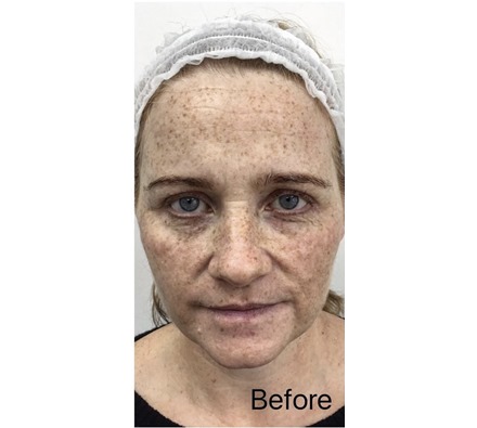Before and after Obagi Nu derm skin transformation