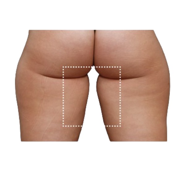 Dr Leah Clinics EmSculpt Neo thigh and bum lift and tightening before and after