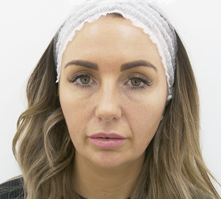 Tear trough treatment before and after