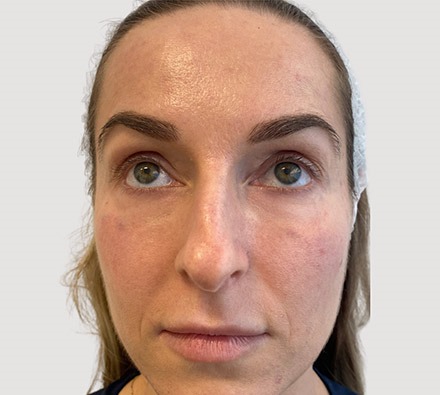 Under eye tear trough filler before and after