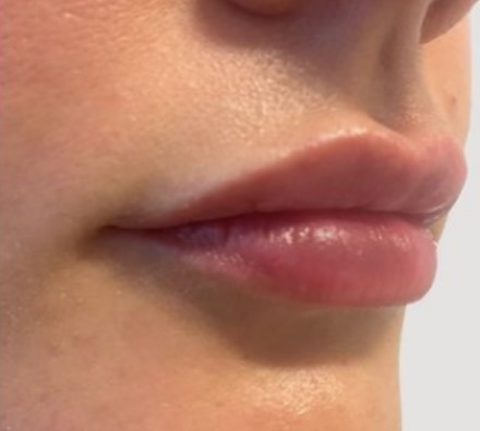 Lip filler (1ml MaiLi) before and after