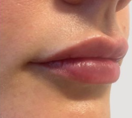 Lip Filler 1ml MaiLi Before and After