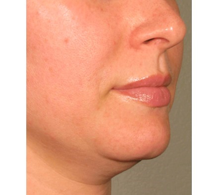 Ultherapy before and after