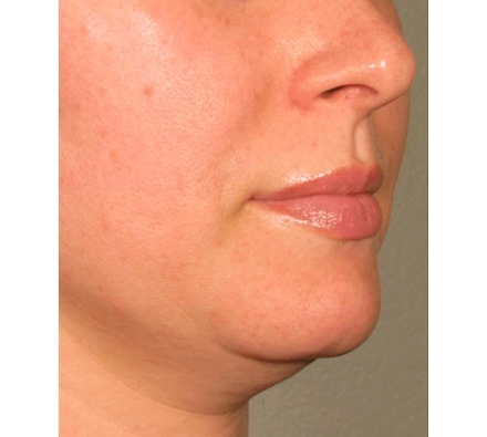 Ultherapy Lower Face Before and After, *Individual results may vary