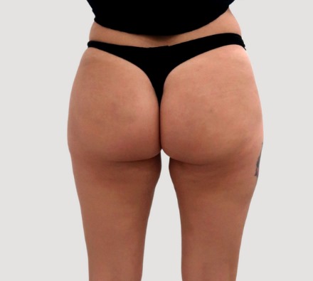 Before and after Lanluma non-surgical bum lift