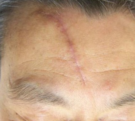 i-pixel harmony laser to treat facial scar 