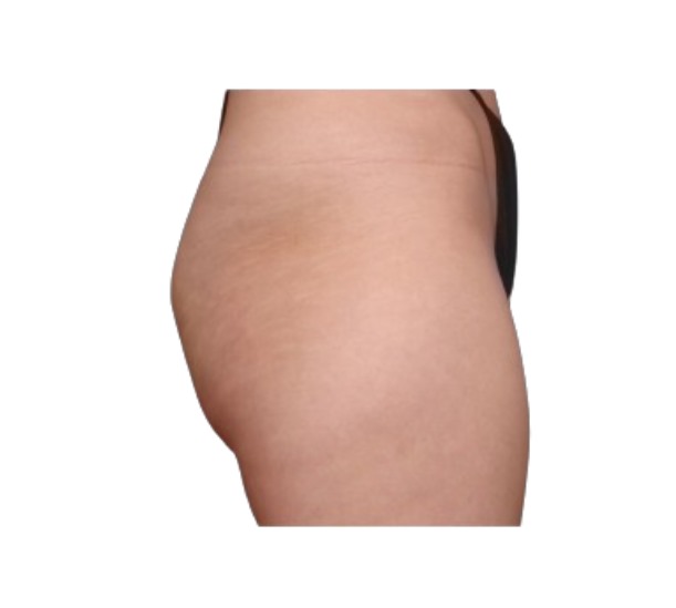EmSculpt Neo bum lift before and after