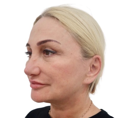 Before and after thread lift