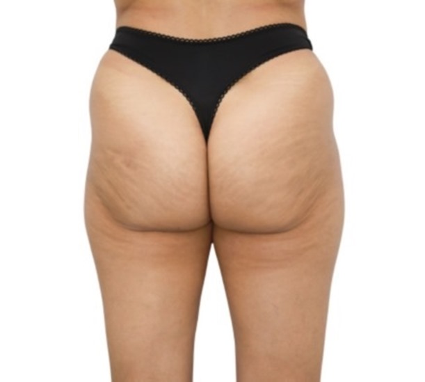 Cellulite on buttocks (before and after Lanluma treatment)