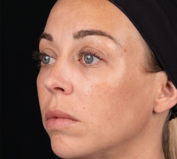 2 days after treatment