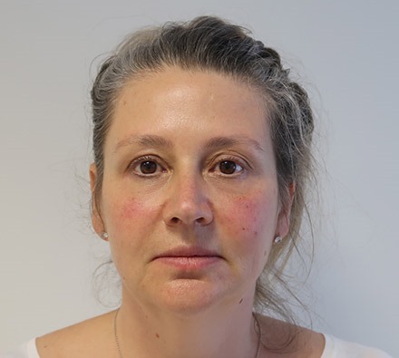 Under eye tear trough filler before and after
