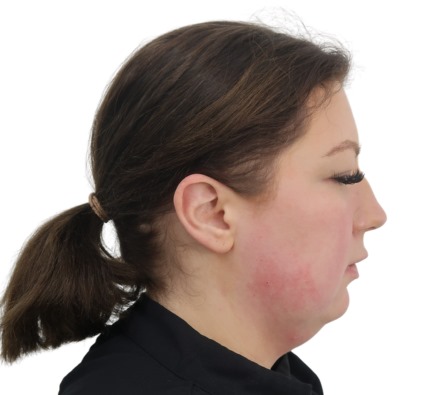 Before and after fat dissolving treatment