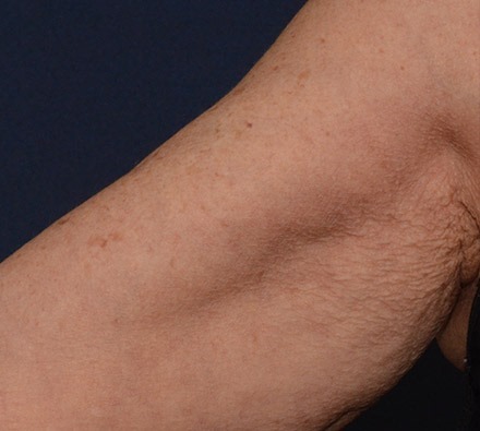 Profhilo underarm before and after