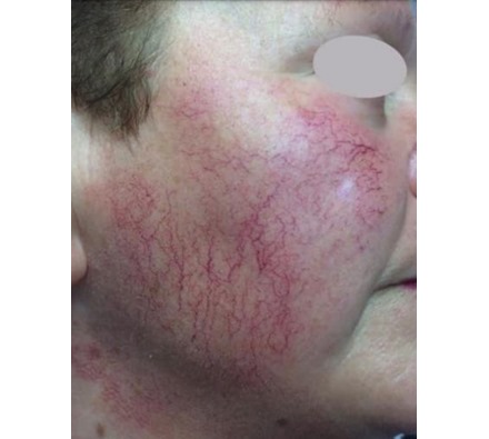 Rosacea before and after vascular laser treatment