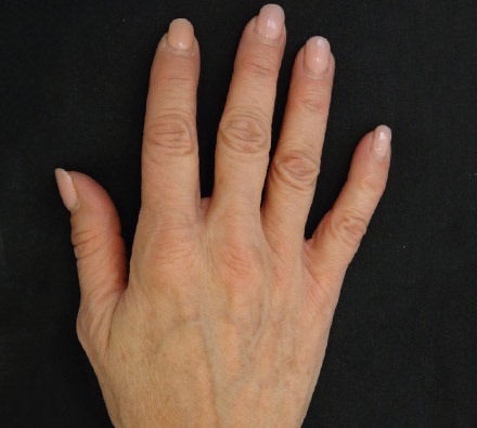 Profhilo hands before and after