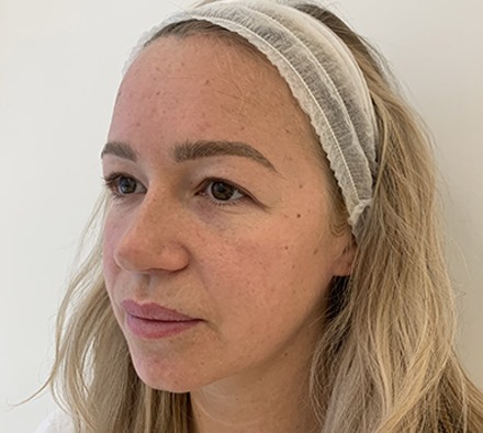 Fox eye lift before and after 