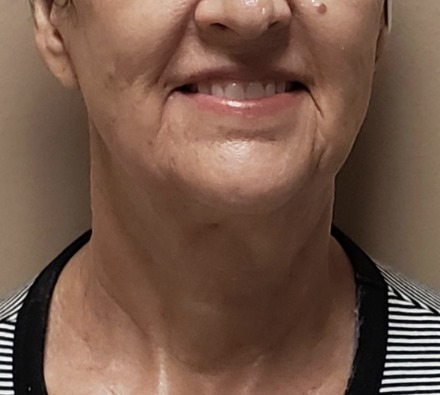 Neck before and after Morpheus8 treatment. Individual results may vary.