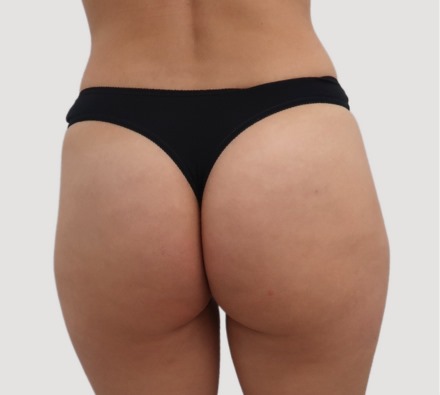 Before and after Lanluma non-surgical bum lift
